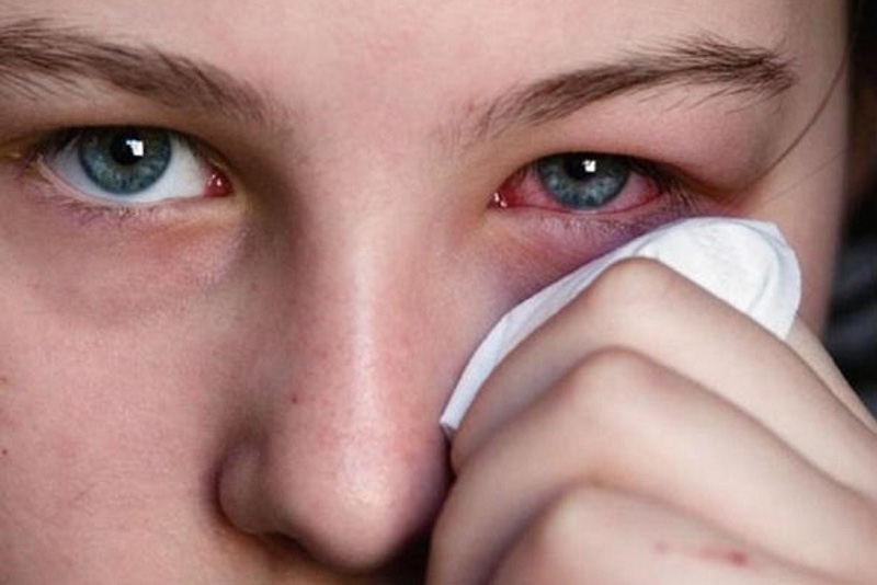 ‬نشانه های‭ ‬عفونت‭ ‬چشم‭ ‬چیست؟‭ ‬