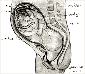 بُرش طولى رحم يک زن باردار
