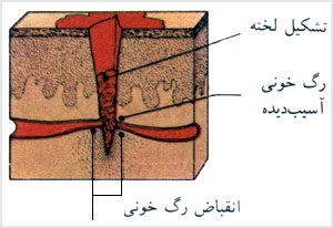 برش مقطعى پوست که نشاندهنده ناحيه آسيب ديده است