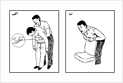 روش هايمليچ (Heimlich)