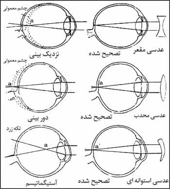 علل نزديکبيني، دوربيني، آستيگماتيسم و طرق درمان آنها