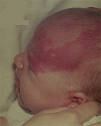 Nevus Flammeus