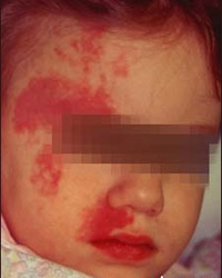 Port Wine Stain