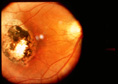 Toxoplasmosis