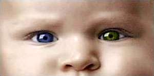 (هتروکروميا) (Heterochromia)