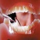مواد قندی عاملی مهم در پوسیدگی دندان‌ها است