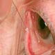 در صورت بی‌توجهی به عارضه خشكی چشم، بیماری تا روی سطح چشم گسترش می‌یابد