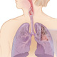 عفونتهای تنفسی كودكان زمینه‌ساز بیماری انسدادی ریه است