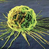 درمان عوارض رادیوتراپی سرطان سینه