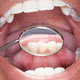 پیشگیری از پوسیدگی دندان‌ها با مصرف آب آشامیدنی حاوی فلوراید