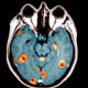 درمان یكی از شدیدترین انواع سرطان مغز با استفاده از نانوپوسته‌ها
