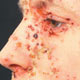معالجه عفونت‌های پوستی به وسیله گرمادرمانی‌