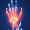 عامل تشدید درد ناشی از التهاب مفصلی چیست؟