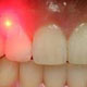 تشخیص زودرس پوسیدگی دندان با لیزر میسر شد