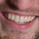 چطور از زرد شدن دندانها جلوگیری کنیم؟