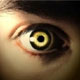 سفید شدن مردمک و انحراف چشم نشانه سرطان چشم در کودکان