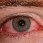 سرماخوردگی از شایع‌ترین علل ابتلا به عفونت‌های چشمی