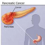 سرطان پانکراس، پنجمین سرطان کشنده