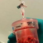 روش جدید تخلیه لخته خون از قلب بیمار، جایگزین عمل باز