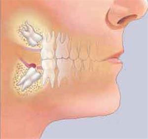 آیا دندان های عقل شما تهدیدی برای سلامت دندانهای شماست؟