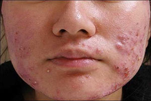 درمان جوش صورت؛ از ماسک‌های گیاهی تا ماساژ پوست
