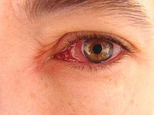 گلوکوم یا آب‌سیاه چشم چیست و چه نشانه‌هایی دارد؟