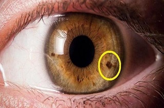 آیا لک های چشم نشانه سرطان هستند؟