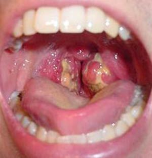 استرپتوکوکهای دهان