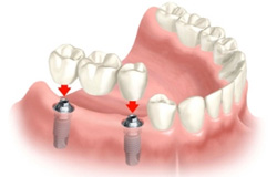 مراقبت از ایمپلنت دندانی را یاد بگیرید
