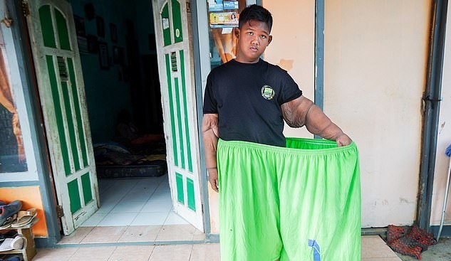 آرزوی چاق ترین پسر جهان برآورده شد، کاهش وزن ۱۰۶ کیلوگرمی! | تصاویر