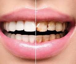 رعایت سه نکته مهم در جلوگیری از پوسیدگی دندان