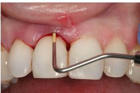 جرم گیری  دندان به روش های طبیعی
