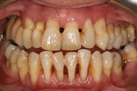 پیوره لثه و از دست دادن زود هنگام دندان ها