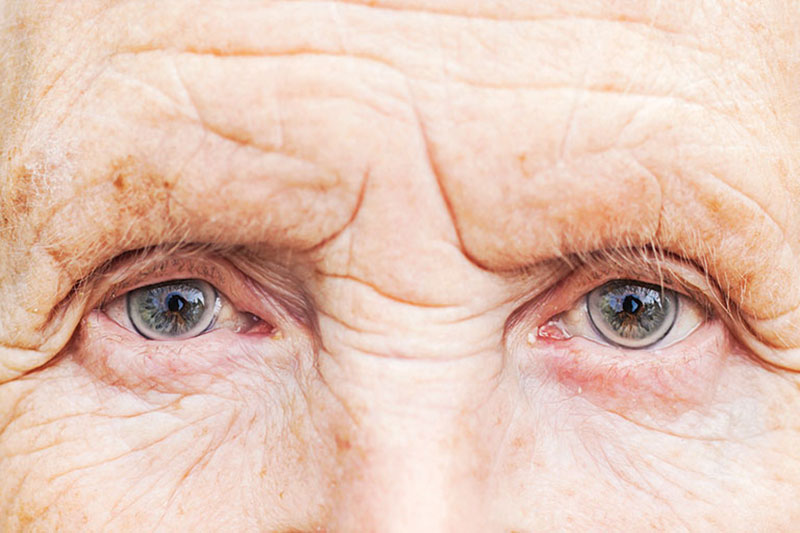 ماکولا؛ دشمن خطرناک برای چشم + راه‌های درمانی