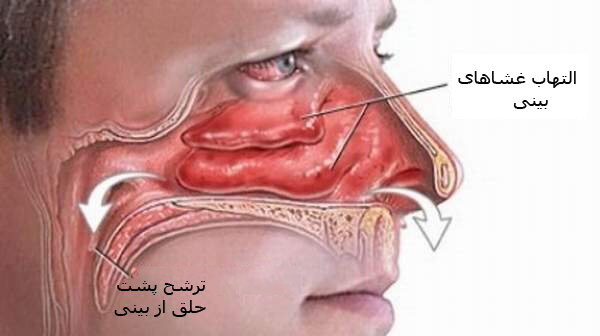 نکته بهداشتی: درمان ترشح پشت حلق از بینی