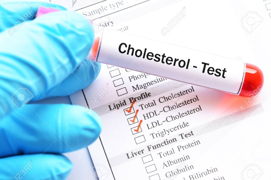 نکته بهداشتی: آیا باید آزمایش کلسترول بدهم؟