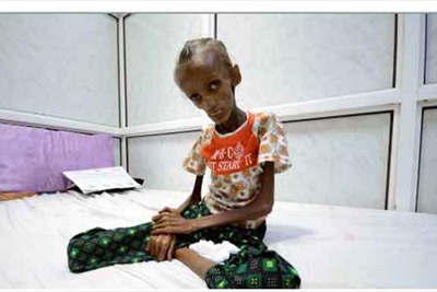 تصاویری دردناک و تکان دهنده از دختر ۱۸ ساله یمنی که همه را شوکه کرد