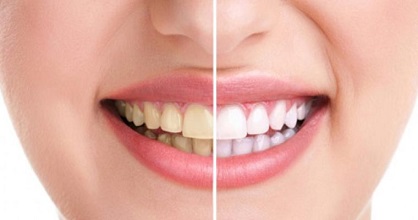 مواد قندی چطور دندان های شما را از بین می برند؟