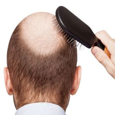 ریزش مو تا چه اندازه طبیعی است؟
