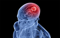  چرا تومورهای مغزی در مردان شایع‌ترند؟