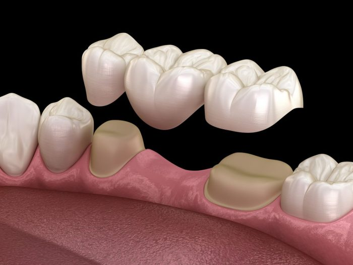 پروتز متحرک دندان چیست و در چه مواقعی استفاده می شود؟